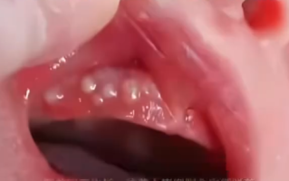 消毒险酿致命错！2个月宝宝被奶奶擦碘伏进ICU ！