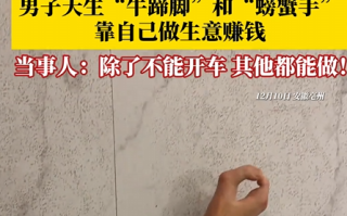 男子天生“牛蹄脚”“螃蟹手” 当事人：自己有能力赚钱 3个孩子都健康 ！