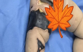 女婴遭虫咬多次抢救全身换血：诊断为脓毒血症 多器官衰竭 !