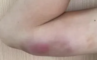 13岁男孩手臂长瘤确诊猫抓病 医生：或因其常喂流浪猫 !