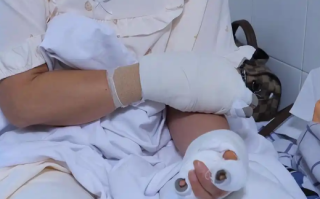 贵阳阿姨河道捡到漂亮石头 竟自燃导致自己四肢烧伤 ！