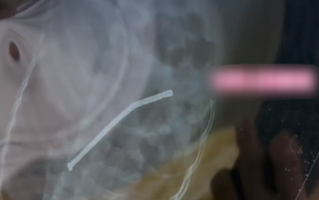 3岁娃吞下40多颗磁力珠致胃穿孔 奶奶以为能自行排出 !