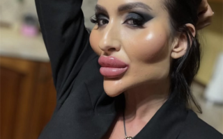 乌克兰网红狂打玻尿酸整出外星脸 网友：比鬼还骇人！