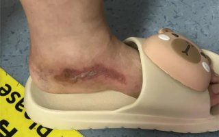 女子为防蚊往鞋里倒敌敌畏：双脚布满水泡走路困难 !