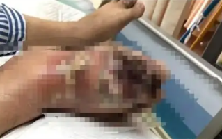 险些截肢！男子每天喝3罐可乐痛风石撑破皮肉 伤口溃烂巨大 !