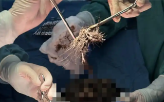 15岁少女吃头发成瘾：属于异食癖 胃里取出4斤发石 !