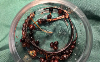 33岁女子戴手镯10年不摘：长胖后嵌进肉里严重感染 ！