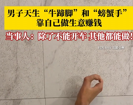 男子天生“牛蹄脚”“螃蟹手” 当事人：自己有能力赚钱 3个孩子都健康 ！-第1张图片-乍过网